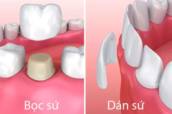 Bọc Răng Sứ Và Dán Răng Sứ