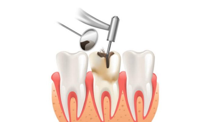 Lấy tủy bọc răng sứ giá bao nhiêu