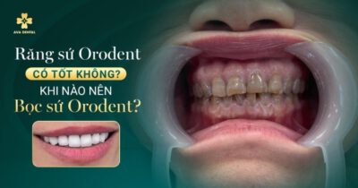 Răng sứ Orodent có tốt không