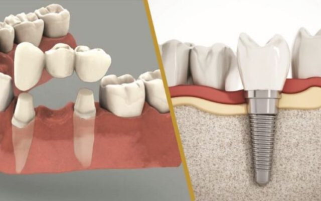 Trồng Răng Implant Và Bọc Răng Sứ