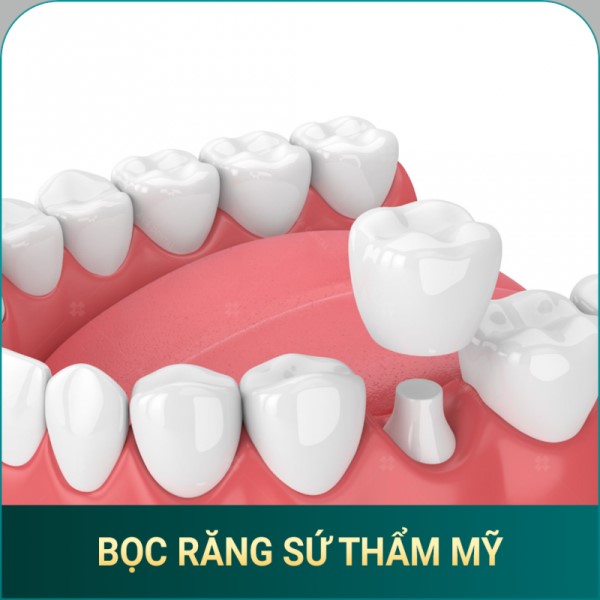 Boc rang su tham my Ava Dental