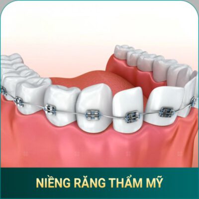 Nieng rang tham my AVA Dental