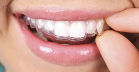 hinh anh gia nieng rang invisalign bao nhieu 1