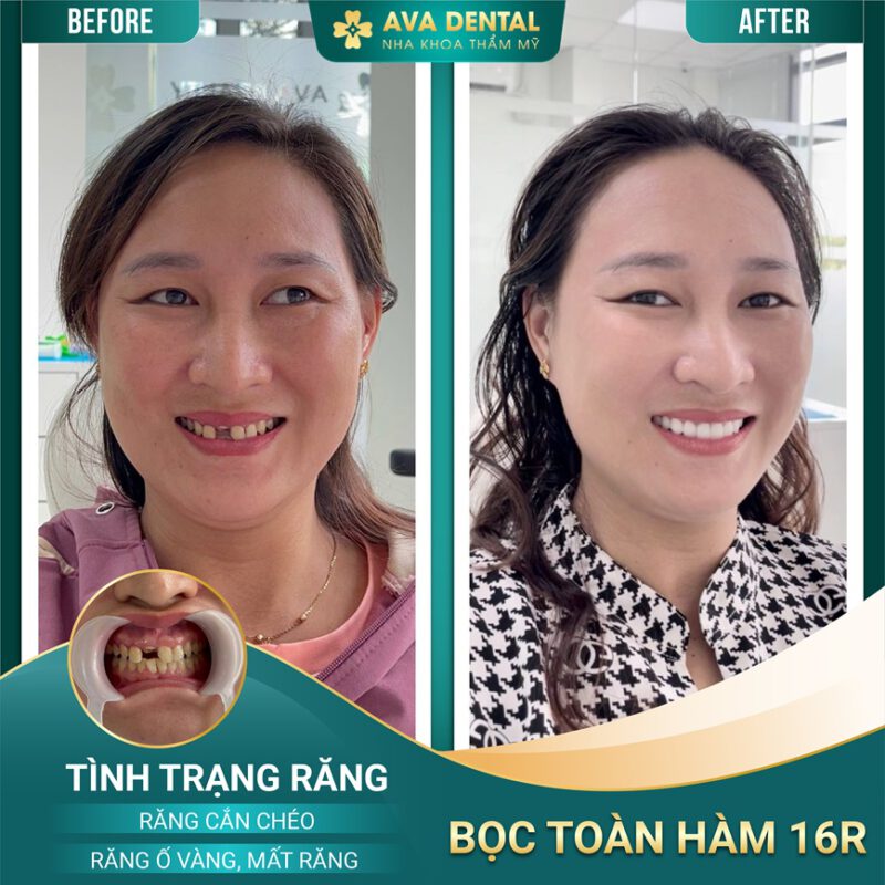 BOC RANG SU THAM MY 02 2