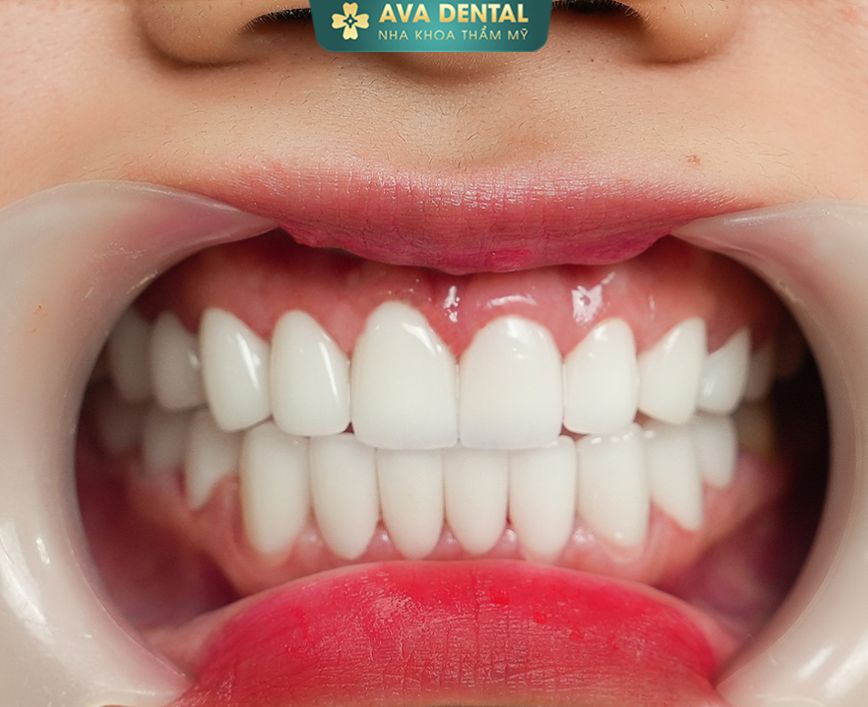 chi phi boc rang su gia bao nhieu tai nha khoa ava dental 2