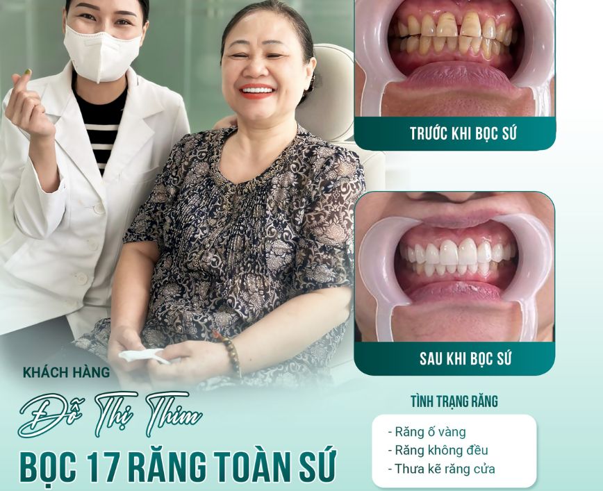 chi phi boc rang su gia bao nhieu tai nha khoa ava dental