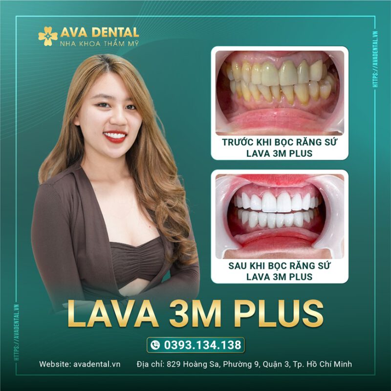 CERCON HT VA LAVA 3M PLUS 02