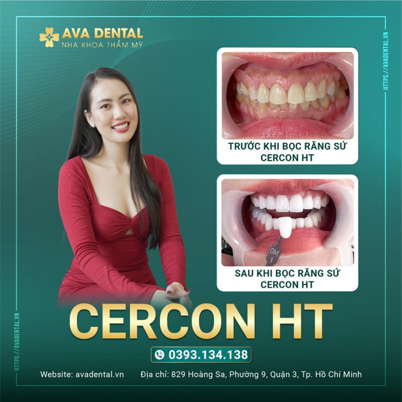 CERCON HT VA LAVA 3M PLUS 03